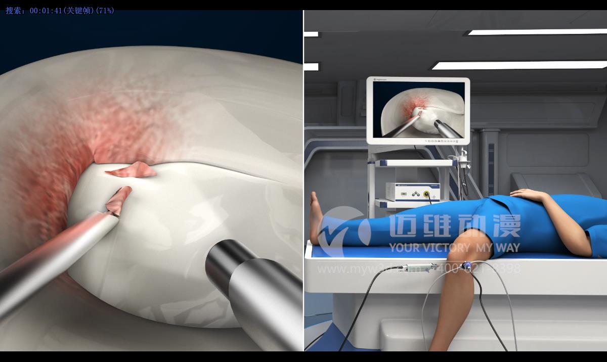 人體手術三維動畫.jpg